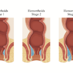 cuantos-paquetes-hemorroidales-tenemos