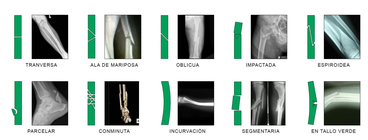 cuantos tipos de fractura hay
