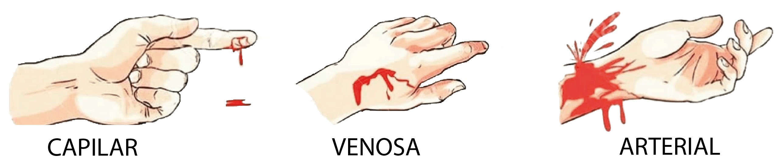 cuantos tipos de heridas hay