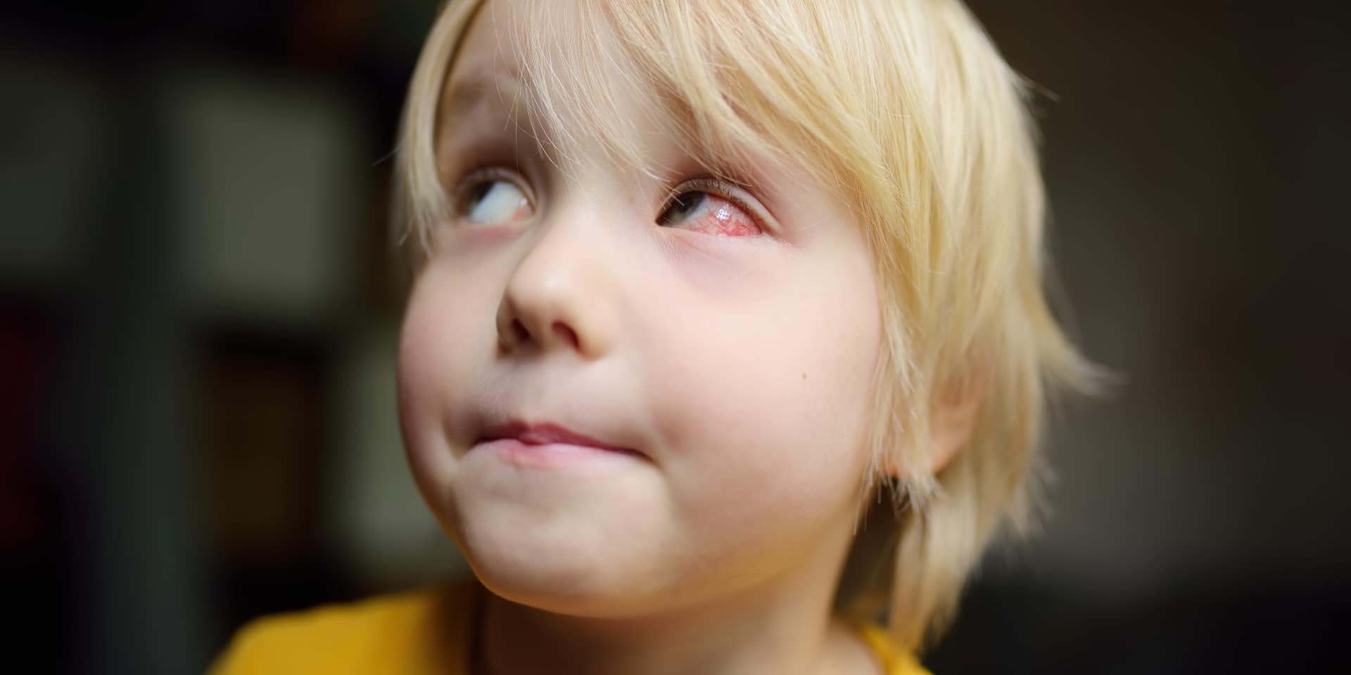 Blog 12 derrame ocular cuanto dura