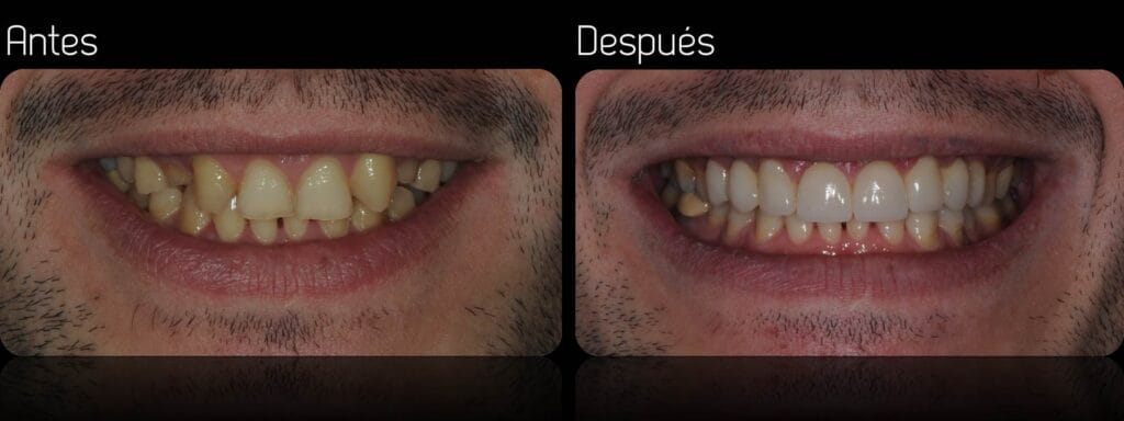 dientes de porcelana cuanto duran
