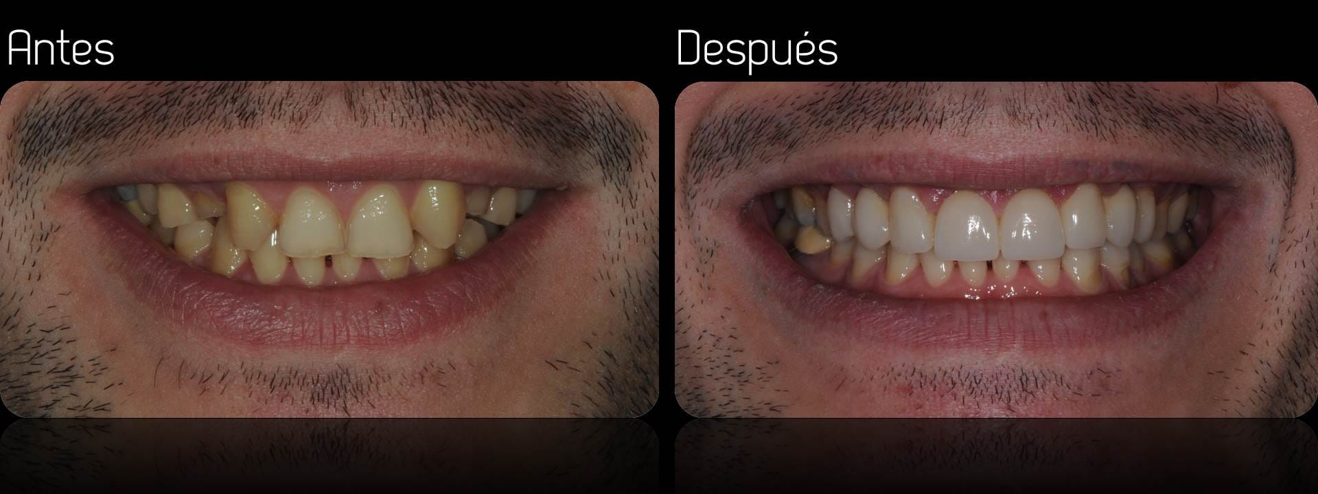 Blog 4 dientes de porcelana cuanto duran