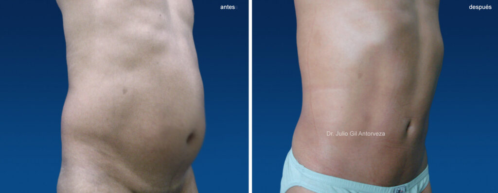 En cuanto sale una liposucción? 2 en cuanto sale una liposuccion