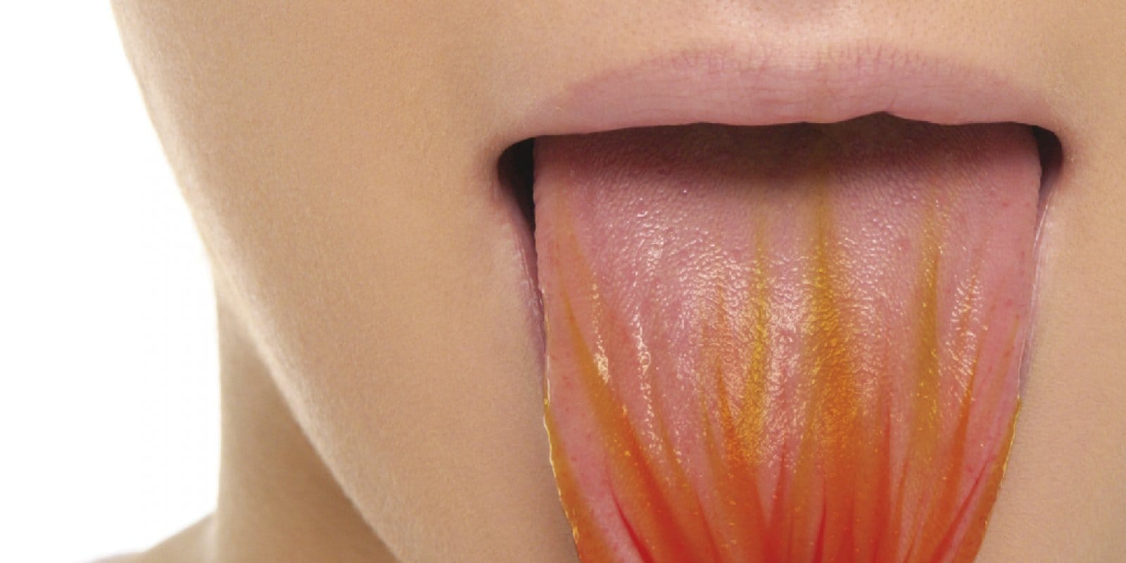 lengua quemada cuanto dura