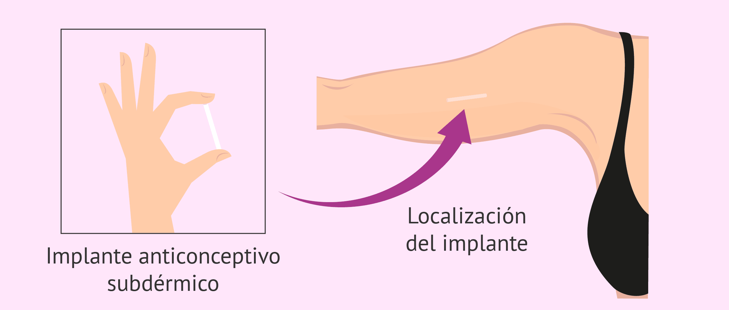 metodo anticonceptivo implante cuanto cuesta