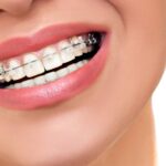 precio-cuanto-cuesta-los-brackets