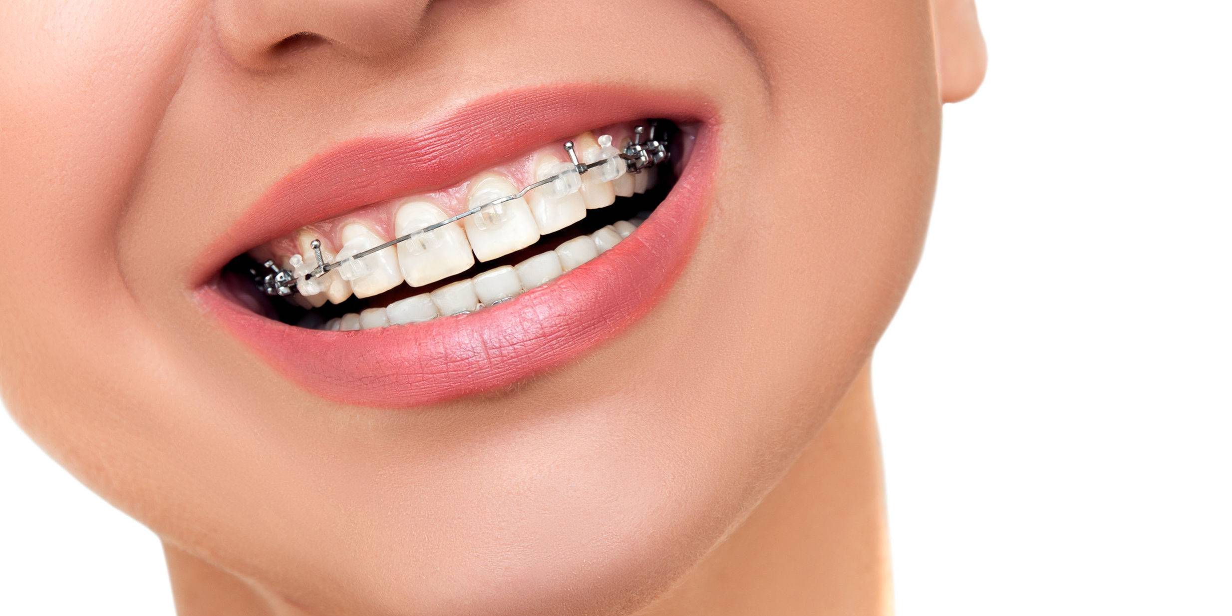 precio cuanto cuesta los brackets