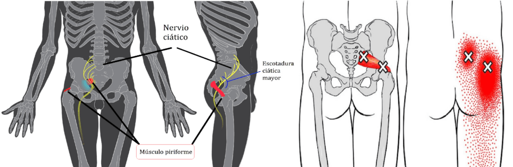 sindrome piramidal cuanto dura