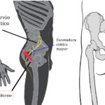 sindrome-piramidal-cuanto-dura
